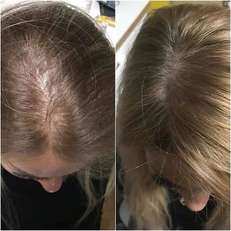 Innerbloom Minoxidil Drops