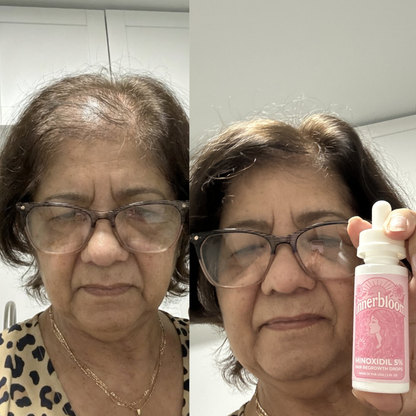 Minoxidil 5% Hair Growth Drops for Women (Made in USA) 2 Pack